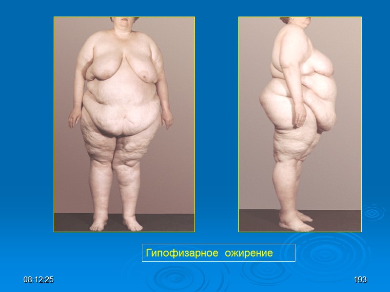 08:12:02 Гипофизарное  ожирение 193